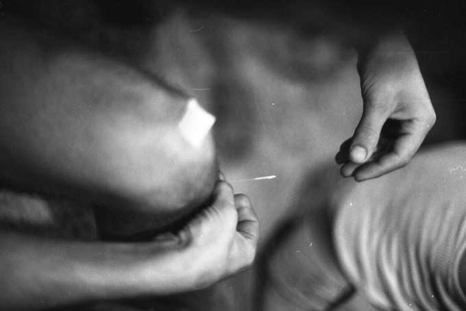 A black and white photograph of a person inserting a thin acupuncture needle into their knee. The figure's hands are in focus and their knee is slightly blurry